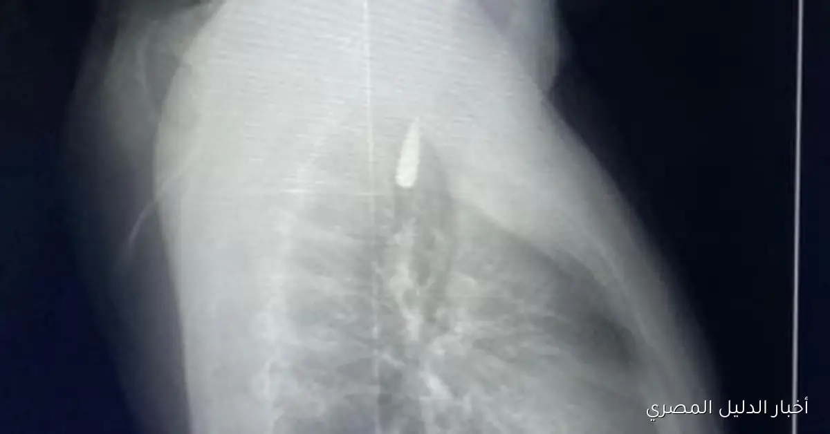 إنجاز طبي جديد في جامعة الإسكندرية يُسهم في إنقاذ حياة مريض فلسطيني من قطاع غزة